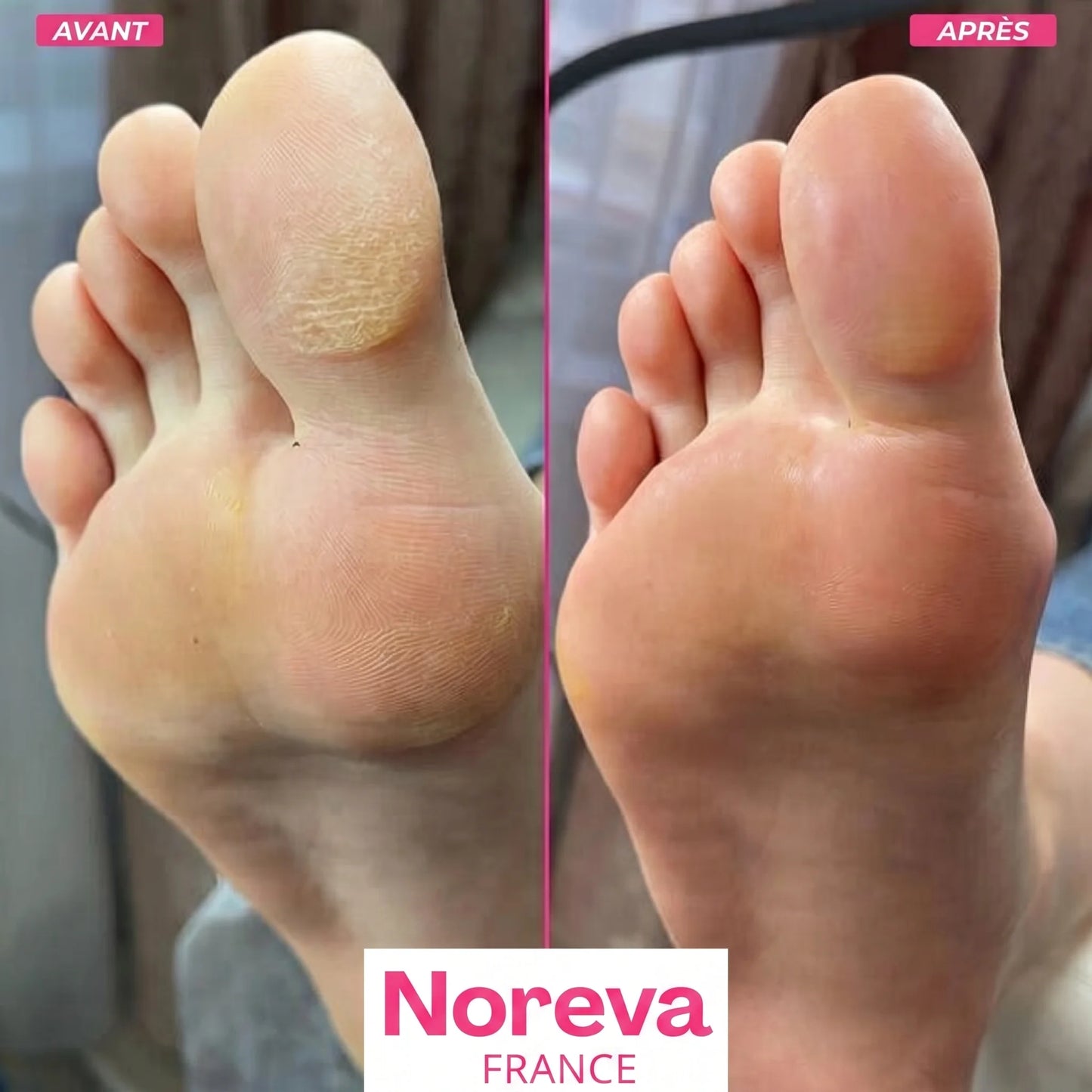 FootGlow Râpe Anti-corne Noreva