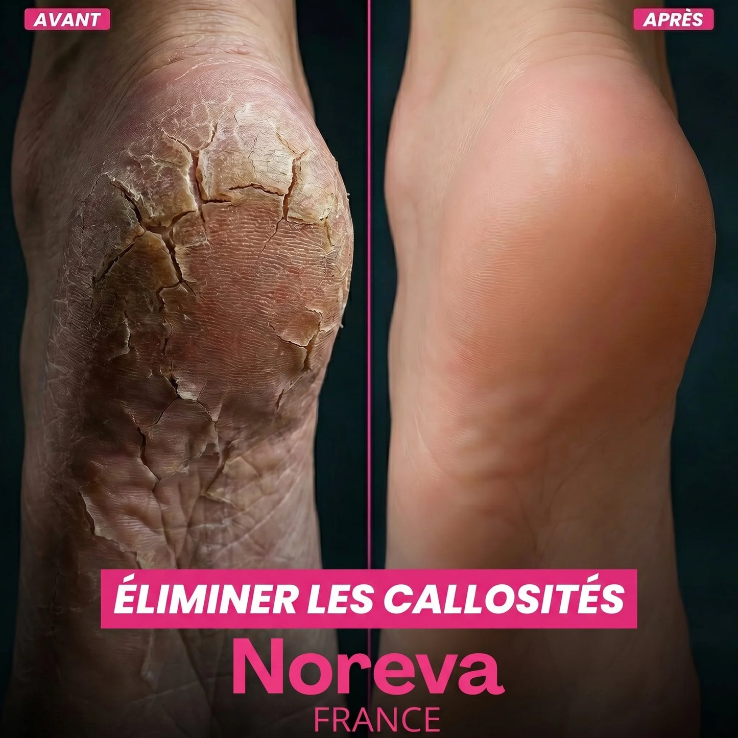 FootGlow Râpe Anti-corne Noreva